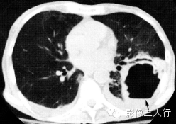 肺囊性病变的鉴别诊断 肺囊性病变的鉴别诊断