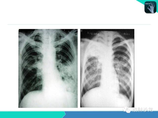 【PPT】不典型肺结核影像学鉴别诊断