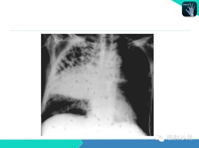 【PPT】不典型肺结核影像学鉴别诊断