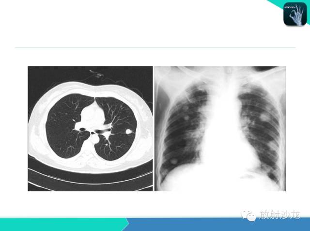 【PPT】不典型肺结核影像学鉴别诊断