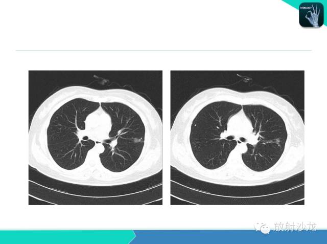 【PPT】不典型肺结核影像学鉴别诊断