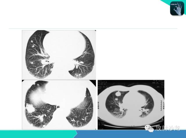 【PPT】不典型肺结核影像学鉴别诊断