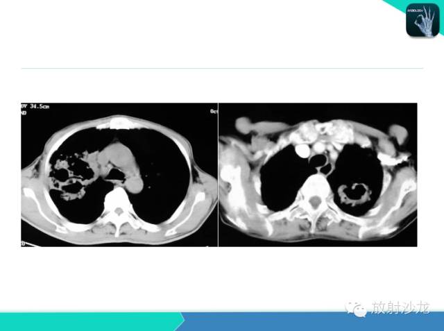 【PPT】不典型肺结核影像学鉴别诊断