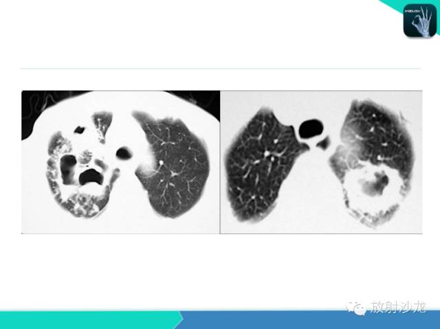 【PPT】不典型肺结核影像学鉴别诊断