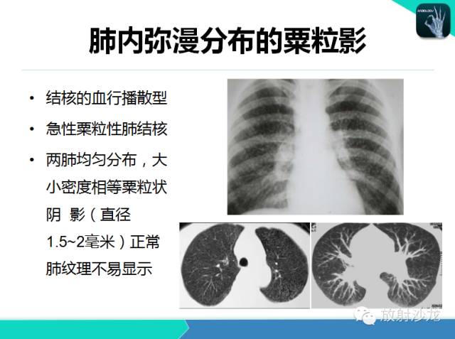 【PPT】不典型肺结核影像学鉴别诊断