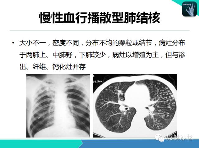 【PPT】不典型肺结核影像学鉴别诊断