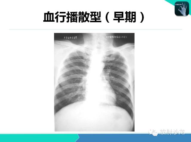 【PPT】不典型肺结核影像学鉴别诊断