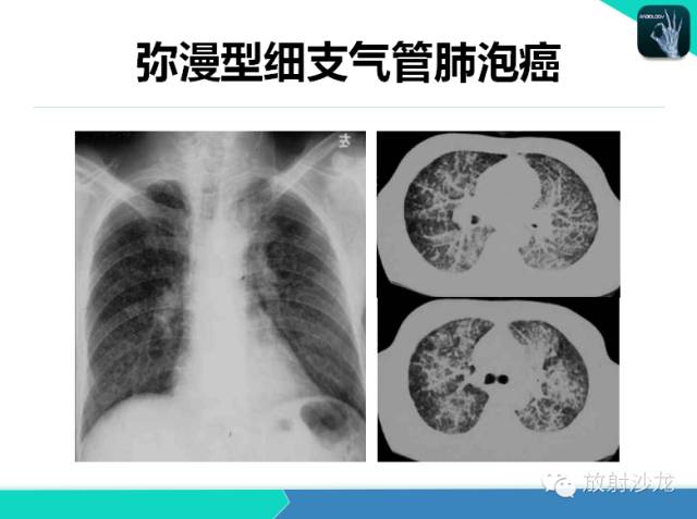 【PPT】不典型肺结核影像学鉴别诊断