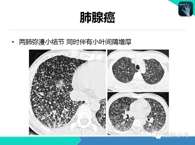 【PPT】不典型肺结核影像学鉴别诊断
