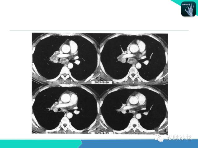 【PPT】不典型肺结核影像学鉴别诊断