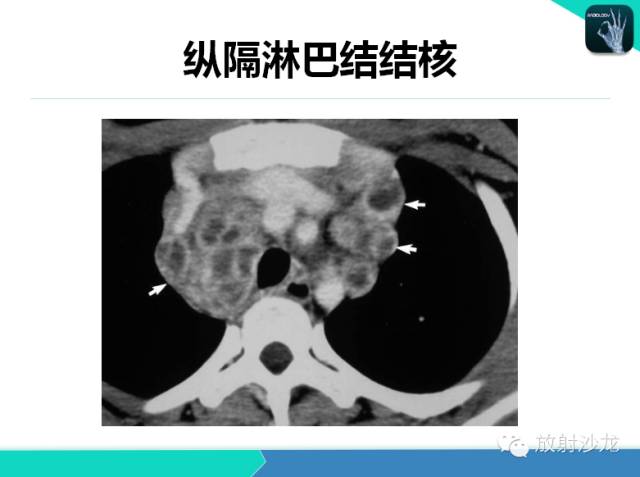 【PPT】不典型肺结核影像学鉴别诊断