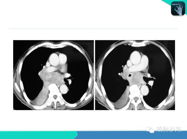 【PPT】不典型肺结核影像学鉴别诊断