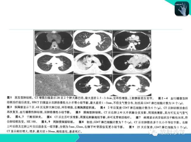 【PPT】不典型肺结核影像学鉴别诊断