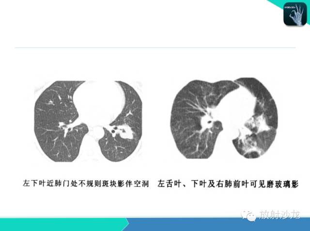 【PPT】不典型肺结核影像学鉴别诊断