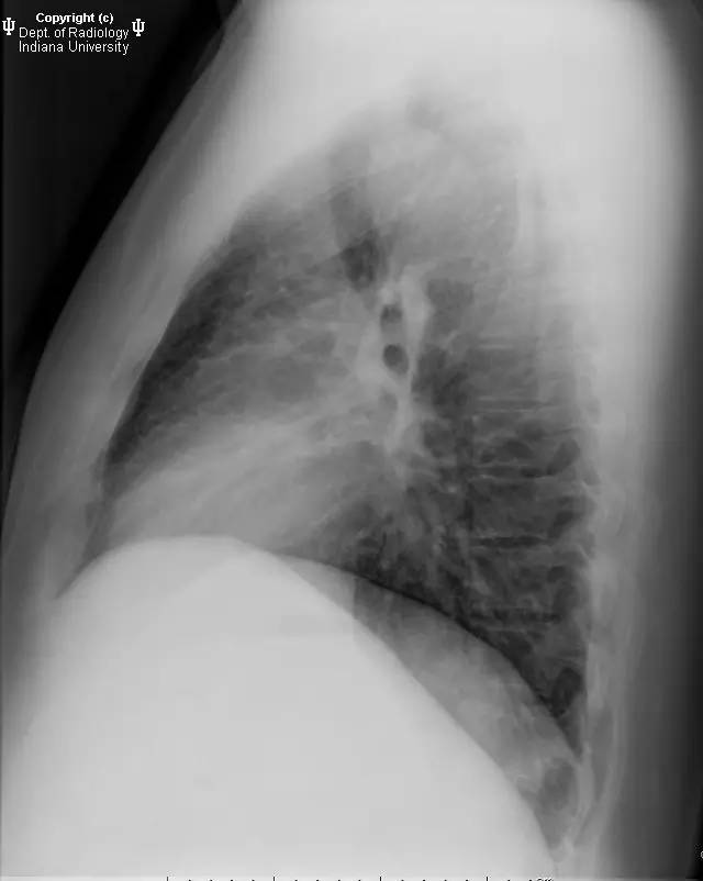 【病例】右位主动脉弓并迷走左锁骨下动脉1例 【病例】右位主动脉弓并迷走左锁骨下动脉1例