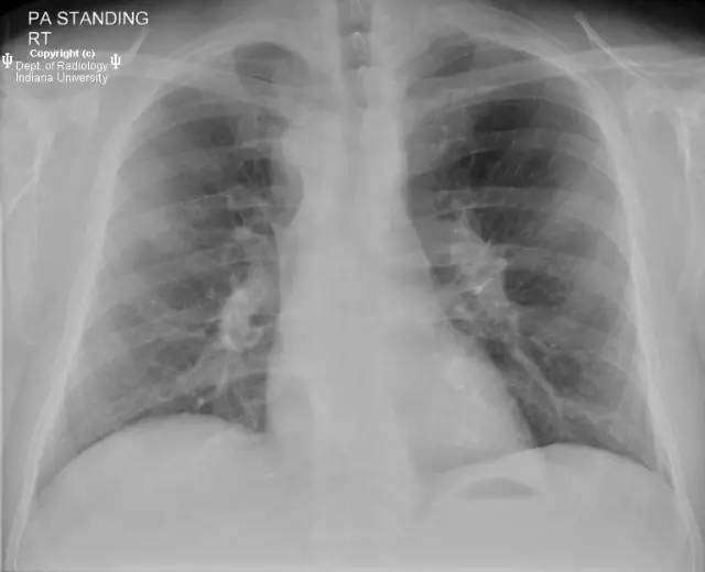 【病例】右位主动脉弓并迷走左锁骨下动脉1例 【病例】右位主动脉弓并迷走左锁骨下动脉1例