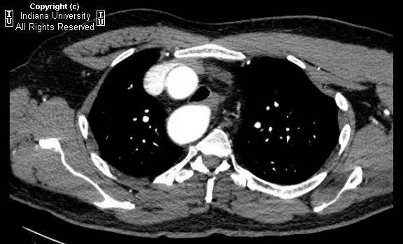 【病例】右位主动脉弓并迷走左锁骨下动脉1例 【病例】右位主动脉弓并迷走左锁骨下动脉1例