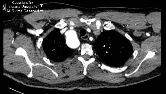 【病例】右位主动脉弓并迷走左锁骨下动脉1例 【病例】右位主动脉弓并迷走左锁骨下动脉1例