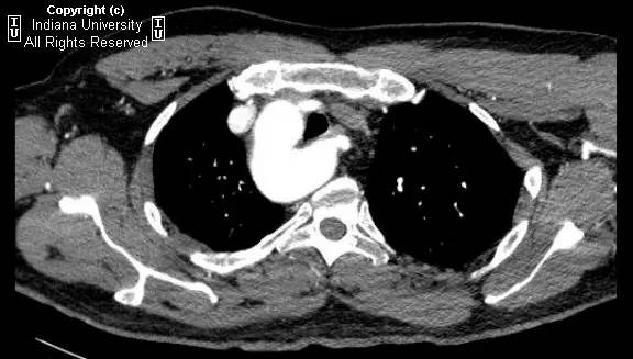 【病例】右位主动脉弓并迷走左锁骨下动脉1例 【病例】右位主动脉弓并迷走左锁骨下动脉1例