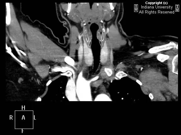 【病例】右位主动脉弓并迷走左锁骨下动脉1例 【病例】右位主动脉弓并迷走左锁骨下动脉1例
