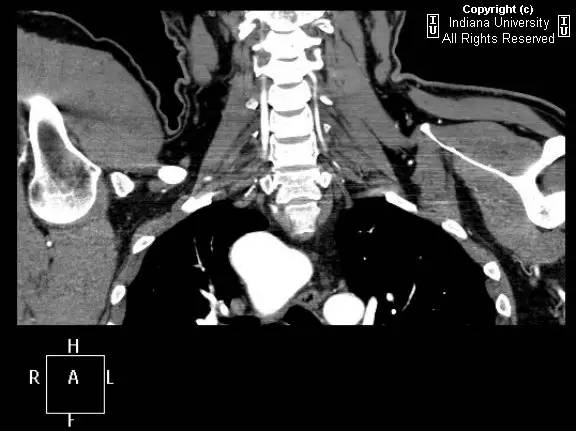 【病例】右位主动脉弓并迷走左锁骨下动脉1例 【病例】右位主动脉弓并迷走左锁骨下动脉1例