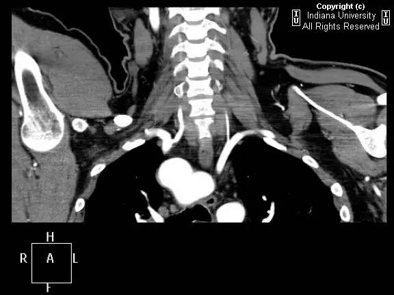 【病例】右位主动脉弓并迷走左锁骨下动脉1例 【病例】右位主动脉弓并迷走左锁骨下动脉1例