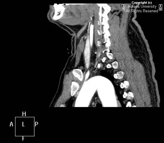【病例】右位主动脉弓并迷走左锁骨下动脉1例 【病例】右位主动脉弓并迷走左锁骨下动脉1例