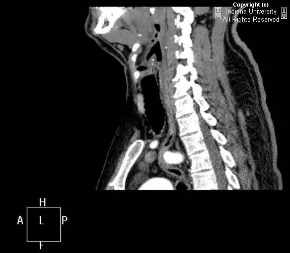 【病例】右位主动脉弓并迷走左锁骨下动脉1例 【病例】右位主动脉弓并迷走左锁骨下动脉1例