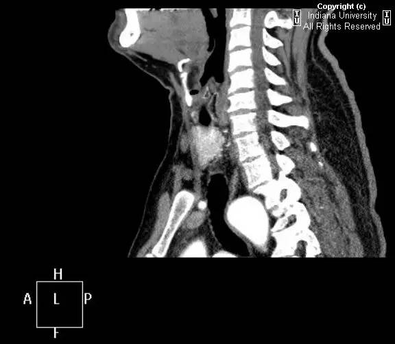 【病例】右位主动脉弓并迷走左锁骨下动脉1例 【病例】右位主动脉弓并迷走左锁骨下动脉1例