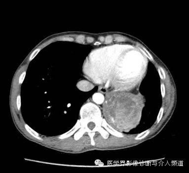 【病例】肺部纱布瘤1例CT影像表现 【病例】肺部纱布瘤1例CT影像表现