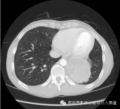 【病例】肺部纱布瘤1例CT影像表现 【病例】肺部纱布瘤1例CT影像表现