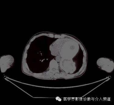 【病例】肺部纱布瘤1例CT影像表现 【病例】肺部纱布瘤1例CT影像表现