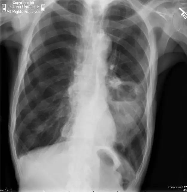 【病例】癌性空洞1例CT影像表现