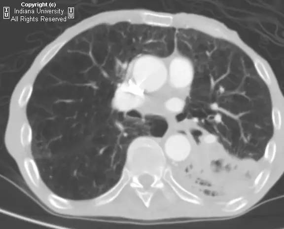 【病例】癌性空洞1例CT影像表现