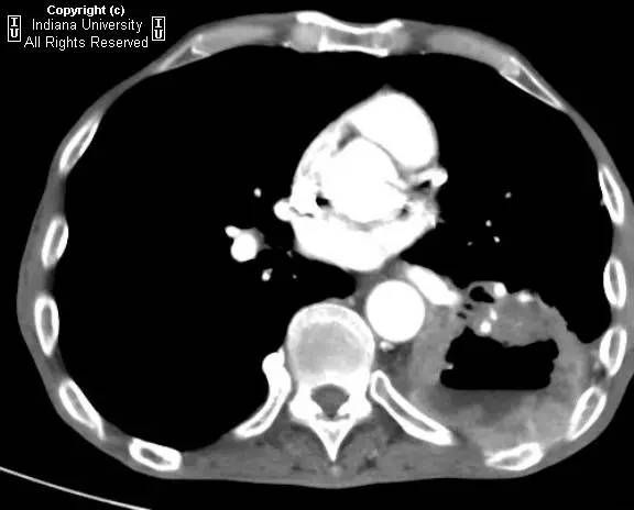 【病例】癌性空洞1例CT影像表现