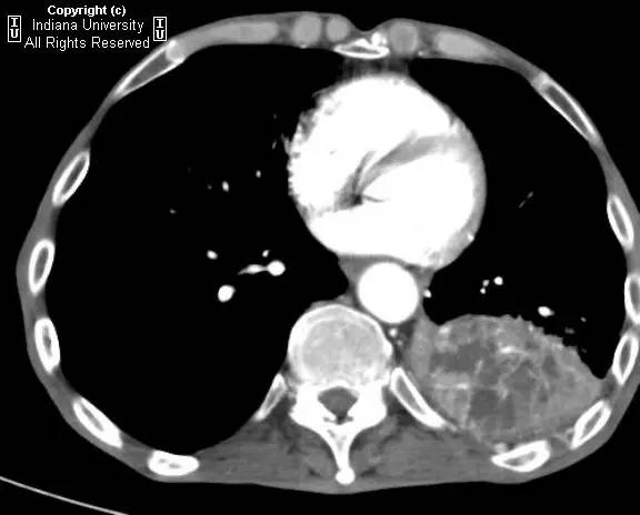 【病例】癌性空洞1例CT影像表现