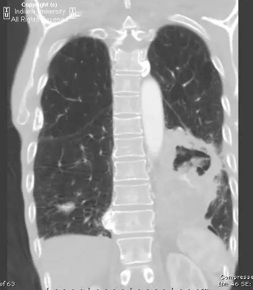 【病例】癌性空洞1例CT影像表现