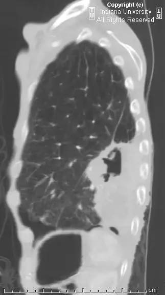 【病例】癌性空洞1例CT影像表现