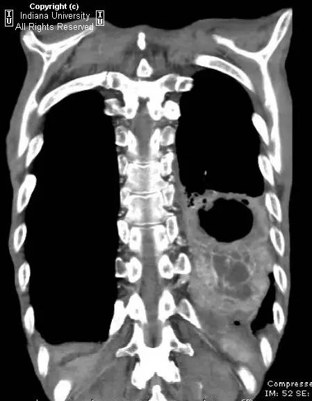 【病例】癌性空洞1例CT影像表现