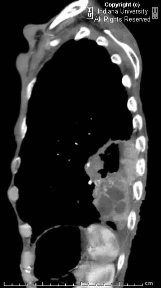 【病例】癌性空洞1例CT影像表现