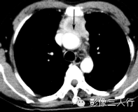 纵隔常见实性疾病的鉴别诊断