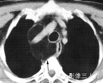 纵隔常见实性疾病的鉴别诊断