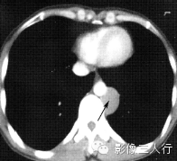 纵隔常见实性疾病的鉴别诊断