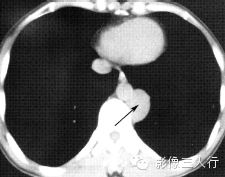 纵隔常见实性疾病的鉴别诊断