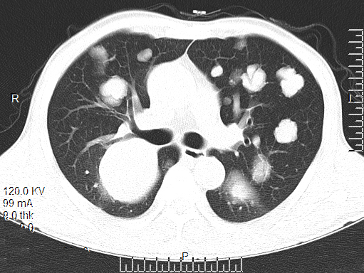 【病例】食管癌肺转移1例X线CT影像表现