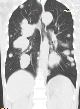 【病例】食管癌肺转移1例X线CT影像表现
