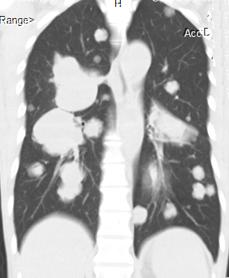 【病例】食管癌肺转移1例X线CT影像表现