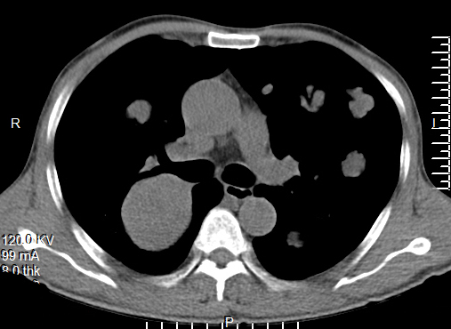 【病例】食管癌肺转移1例X线CT影像表现
