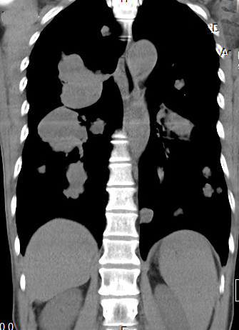 【病例】食管癌肺转移1例X线CT影像表现