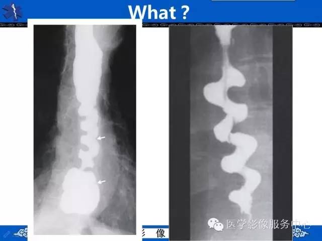 【影像征象】开瓶器征——食管痉挛